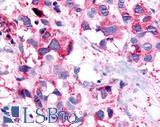 PTGER1 / EP1 Antibody - Breast, Carcinoma
