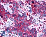 PTGER4 / EP4 Antibody - Colon, Carcinoma