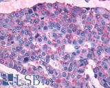 PTGIR / IP Receptor Antibody - Lung, Non Small-Cell Carcinoma