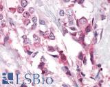 PTPRA / RPTP-Alpha Antibody - Breast, Carcinoma