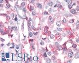 PTPRA / RPTP-Alpha Antibody - Breast, Carcinoma