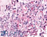 PTPRE / PTP Epsilon Antibody - Breast, Carcinoma
