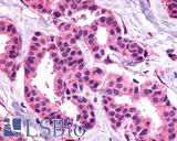 SSTR1 Antibody - Breast, Carcinoma