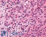 SSTR3 Antibody - Breast, Carcinoma