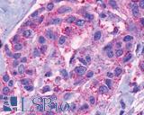 TACR2 / NK2R Antibody - Breast, Carcinoma