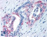 TRPM8 Antibody - Anti-TRPM8 antibody IHC of human Pancreas, Carcinoma. Immunohistochemistry of formalin-fixed, paraffin-embedded tissue after heat-induced antigen retrieval.