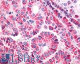 TSH Receptor / TSHR Antibody - Thyroid Papillary Carcinoma