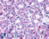 TSH Receptor / TSHR Antibody - Thyroid, Follicular Carcinoma