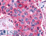VIPR1 Antibody - Breast carcinoma