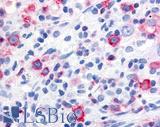 WNT10A Antibody - Non-Hodgkin's lymphoma
