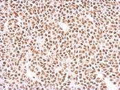 PAX8 Antibody - PAX8 antibody detects PAX8 protein at nucleus on BT483 xenograft by immunohistochemical analysis. Sample: Paraffin-embedded BT483 xenograft. PAX8 antibody dilution:1:500.