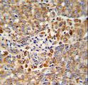 PCA1 / ALKBH3 Antibody - Formalin-fixed and paraffin-embedded human prostate carcinoma reacted with ALKBH3 Antibody , which was peroxidase-conjugated to the secondary antibody, followed by DAB staining. This data demonstrates the use of this antibody for immunohistochemistry; clinical relevance has not been evaluated.