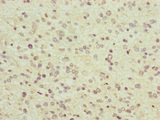 PCDHA12 Antibody - Immunohistochemistry of paraffin-embedded human glioma cancer at dilution of 1:100