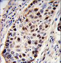 PCNA Antibody - PCNA Antibody immunohistochemistry of formalin-fixed and paraffin-embedded human lung carcinoma followed by peroxidase-conjugated secondary antibody and DAB staining.