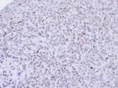 PCNP Antibody - IHC of paraffin-embedded H1299 xenograft using PCNP antibody at 1:500 dilution.