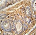 PCOTH Antibody - PCOTH antibody immunohistochemistry of formalin-fixed and paraffin-embedded human prostate carcinoma followed by peroxidase-conjugated secondary antibody and DAB staining.