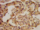 PCSK2 Antibody - Immunohistochemistry image at a dilution of 1:400 and staining in paraffin-embedded human liver cancer performed on a Leica BondTM system. After dewaxing and hydration, antigen retrieval was mediated by high pressure in a citrate buffer (pH 6.0) . Section was blocked with 10% normal goat serum 30min at RT. Then primary antibody (1% BSA) was incubated at 4 °C overnight. The primary is detected by a biotinylated secondary antibody and visualized using an HRP conjugated SP system.