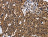 PDCD7 Antibody - Immunohistochemistry of paraffin-embedded Human ovarian cancer using PDCD7 Polyclonal Antibody at dilution of 1:60.