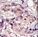 PDGFRA / PDGFR Alpha Antibody - Formalin-fixed and paraffin-embedded human cancer tissue reacted with the primary antibody, which was peroxidase-conjugated to the secondary antibody, followed by DAB staining. This data demonstrates the use of this antibody for immunohistochemistry; clinical relevance has not been evaluated. BC = breast carcinoma; HC = hepatocarcinoma.