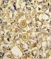 PDGFRB / PDGFR Beta Antibody - Formalin-fixed and paraffin-embedded human breast carcinoma reacted with PDGFRB Antibody , which was peroxidase-conjugated to the secondary antibody, followed by DAB staining. This data demonstrates the use of this antibody for immunohistochemistry; clinical relevance has not been evaluated.