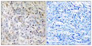 PDIK1L Antibody - Immunohistochemistry analysis of paraffin-embedded human breast carcinoma tissue, using PDIK1L Antibody. The picture on the right is blocked with the synthesized peptide.
