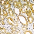 PDK4 Antibody - Immunohistochemical analysis of PDK4 staining in human colon cancer formalin fixed paraffin embedded tissue section. The section was pre-treated using heat mediated antigen retrieval with sodium citrate buffer (pH 6.0). The section was then incubated with the antibody at room temperature and detected using an HRP conjugated compact polymer system. DAB was used as the chromogen. The section was then counterstained with hematoxylin and mounted with DPX.