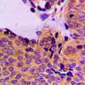 PDPK1 / PDK1 Antibody - Immunohistochemical analysis of PDPK1 (pS241) staining in human breast cancer formalin fixed paraffin embedded tissue section. The section was pre-treated using heat mediated antigen retrieval with sodium citrate buffer (pH 6.0). The section was then incubated with the antibody at room temperature and detected using an HRP conjugated compact polymer system. DAB was used as the chromogen. The section was then counterstained with hematoxylin and mounted with DPX.