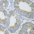 PDYN / ProDynorphin Antibody - Immunohistochemistry of paraffin-embedded human rectal cancer tissue.