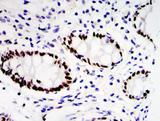 PEA3 / ETV4 Antibody - IHC analysis of paraffin-embedded colon carcinoma tissues 