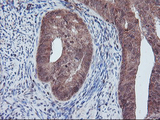 PECR Antibody - IHC of paraffin-embedded Adenocarcinoma of Human endometrium tissue using anti-PECR mouse monoclonal antibody. (Heat-induced epitope retrieval by 10mM citric buffer, pH6.0, 100C for 10min).