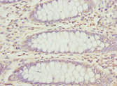PECR Antibody - Immunohistochemistry of paraffin-embedded human colon cancer at dilution 1:100