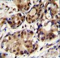 PELP1 Antibody - PELP1 Antibody (Center R759) immunohistochemistry of formalin-fixed and paraffin-embedded human breast carcinoma followed by peroxidase-conjugated secondary antibody and DAB staining.