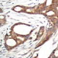 PER2 Antibody - Immunohistochemical analysis of PER2 (pS662) staining in human prostate cancer formalin fixed paraffin embedded tissue section. The section was pre-treated using heat mediated antigen retrieval with sodium citrate buffer (pH 6.0). The section was then incubated with the antibody at room temperature and detected using an HRP polymer system. DAB was used as the chromogen. The section was then counterstained with hematoxylin and mounted with DPX.