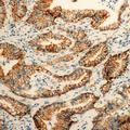 PEX11B Antibody - Immunohistochemical analysis of PEX11B staining in human colon cancer formalin fixed paraffin embedded tissue section. The section was pre-treated using heat mediated antigen retrieval with sodium citrate buffer (pH 6.0). The section was then incubated with the antibody at room temperature and detected using an HRP conjugated compact polymer system. DAB was used as the chromogen. The section was then counterstained with hematoxylin and mounted with DPX.