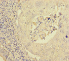 PEX16 Antibody - Immunohistochemistry of paraffin-embedded human lung cancer at dilution of 1:100