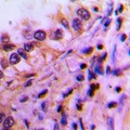 PEX19 Antibody - Immunohistochemical analysis of PEX19 staining in human lung cancer formalin fixed paraffin embedded tissue section. The section was pre-treated using heat mediated antigen retrieval with sodium citrate buffer (pH 6.0). The section was then incubated with the antibody at room temperature and detected with HRP and DAB as chromogen. The section was then counterstained with hematoxylin and mounted with DPX.