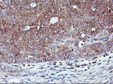 PFDN6 / HKE2 Antibody - IHC of paraffin-embedded Adenocarcinoma of Human ovary tissue using anti-PFDN6 mouse monoclonal antibody.