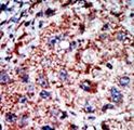 PFKL Antibody - Formalin-fixed and paraffin-embedded human cancer tissue reacted with the primary antibody, which was peroxidase-conjugated to the secondary antibody, followed by AEC staining. This data demonstrates the use of this antibody for immunohistochemistry; clinical relevance has not been evaluated. BC = breast carcinoma; HC = hepatocarcinoma.