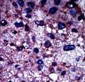 PFKM / PFK-1 Antibody - Formalin-fixed and paraffin-embedded human cancer tissue reacted with the primary antibody, which was peroxidase-conjugated to the secondary antibody, followed by DAB staining. This data demonstrates the use of this antibody for immunohistochemistry; clinical relevance has not been evaluated. BC = breast carcinoma; HC = hepatocarcinoma.