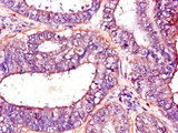 PFKM / PFK-1 Antibody - Immunohistochemistry of paraffin-embedded human endometrial cancer using CSB-PA017823LA01HU at dilution of 1:100