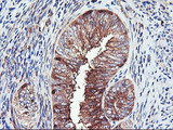 PFKP Antibody - IHC of paraffin-embedded Adenocarcinoma of Human endometrium tissue using anti-PFKP mouse monoclonal antibody.