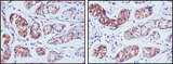 PGA5 / Pepsin A Antibody - IHC of paraffin-embedded human stomach cancer tissues using PGA5 mouse monoclonal antibody with DAB staining.