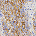 PGC / Pepsin C Antibody - Immunohistochemistry of paraffin-embedded human stomach cancer tissue using PGC antibody at dilution of 1:200 (x400 lens)