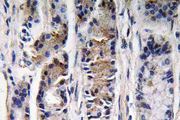PGC / Pepsin C Antibody - IHC of Pepsin C (F306) pAb in paraffin-embedded human lung carcinoma tissue.