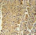 PGD Antibody - PGD Antibody immunohistochemistry of formalin-fixed and paraffin-embedded human lung carcinoma followed by peroxidase-conjugated secondary antibody and DAB staining.