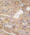 PGK1 / Phosphoglycerate Kinase Antibody - Formalin-fixed and paraffin-embedded human hepatocarcinoma tissue reacted with PGK1 antibody , which was peroxidase-conjugated to the secondary antibody, followed by DAB staining. This data demonstrates the use of this antibody for immunohistochemistry; clinical relevance has not been evaluated.