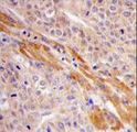 PGK1 / Phosphoglycerate Kinase Antibody - Formalin-fixed and paraffin-embedded human hepatocarcinoma tissue reacted with PGK1 Antibody (Center S320), which was peroxidase-conjugated to the secondary antibody, followed by DAB staining. This data demonstrates the use of this antibody for immunohistochemistry; clinical relevance has not been evaluated.