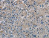 PGLYRP1 / PGRP Antibody - Immunohistochemistry of paraffin-embedded Human liver cancer using PGLYRP1 Polyclonal Antibody at dilution of 1:40.