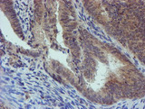 PGM3 Antibody - IHC of paraffin-embedded Adenocarcinoma of Human endometrium tissue using anti-PGM3 mouse monoclonal antibody.