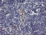 PGM3 Antibody - IHC of paraffin-embedded Human lymphoma tissue using anti-PGM3 mouse monoclonal antibody. (Heat-induced epitope retrieval by 10mM citric buffer, pH6.0, 100C for 10min).